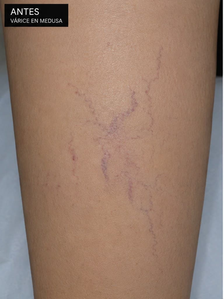 Várice en medusa tratada con escleroterapia — antes